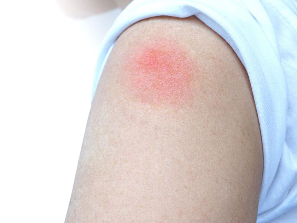 Cánh tay sưng đỏ tại chổ tiêm sau khi tiêm vắc xin có đáng lo?