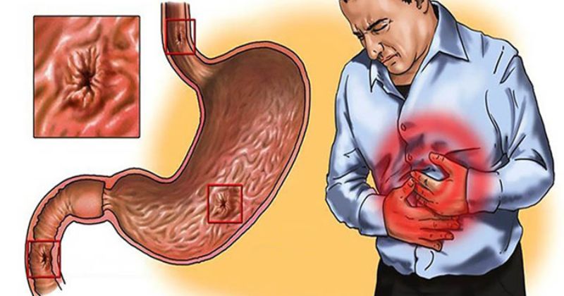 Bài Thuốc Chữa Dạ Dày Bằng Nghệ Và Mật Ong_ Cách Sử Dụng Hiệu Quả Nhất