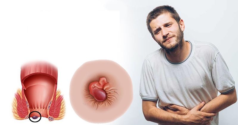 Tác dụng của cây đinh lăng, chiếc lá kỳ diệu của y học 11 Chữa bệnh trĩ