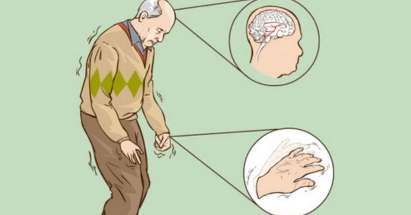 Tác dụng của cây đinh lăng, chiếc lá kỳ diệu của y học 4 Hỗ trợ điều trị Parkinson và Alzheimer
