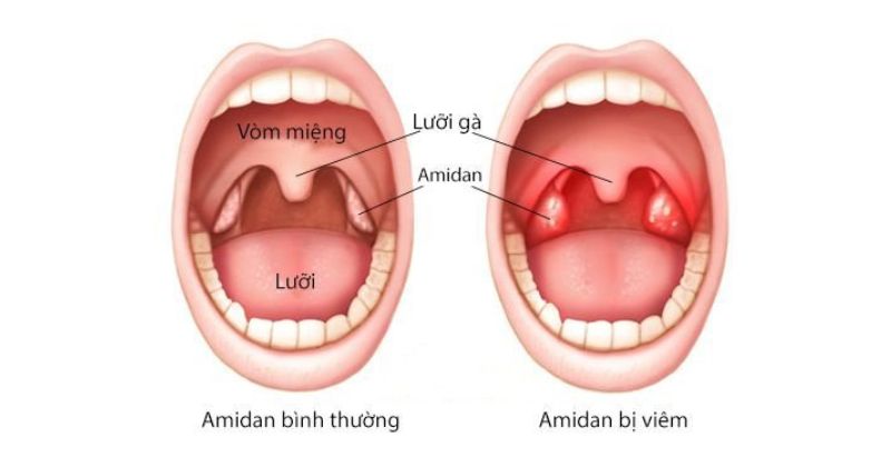 Khi Nào Đau Họng Là Viêm Họng
