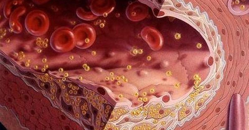 Mỡ Trong Máu: Nguy Cơ Tiềm Ẩn Và Cách Phòng Ngừa Hiệu Quả 2 Máu Nhiễm Mỡ Là Gì