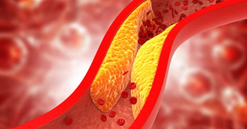 Mỡ Trong Máu: Nguy Cơ Tiềm Ẩn Và Cách Phòng Ngừa Hiệu Quả 3 Phân Loại Máu Nhiễm Mỡ