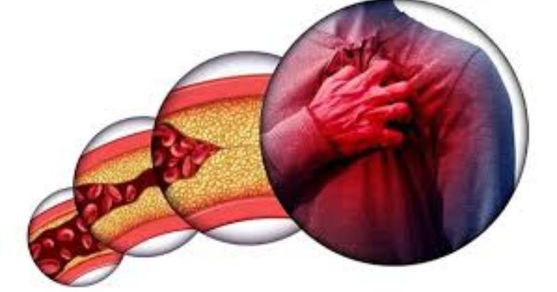 Mỡ Trong Máu: Nguy Cơ Tiềm Ẩn Và Cách Phòng Ngừa Hiệu Quả 4 Triệu Chứng Thường Gặp