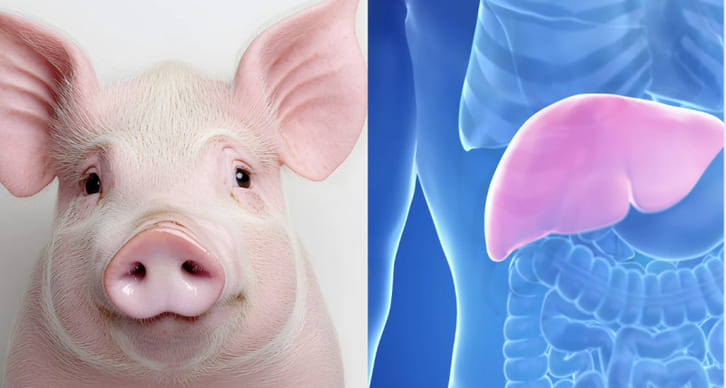 Lần đầu tiên ghép đồng thời gan và thận lợn biến đổi gene cho người