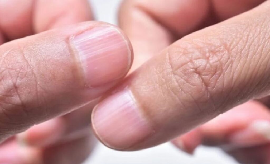 Móng tay có sọc là bệnh gì? Dấu hiệu bệnh lý và cách khắc phục