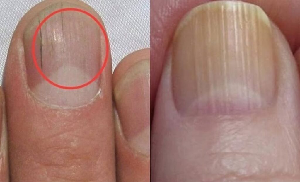 Móng tay có sọc dọc nguy hiểm không 